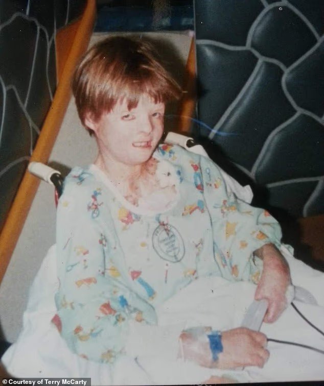 He recalled spending over five hours a day changing his bandages, and being covered in scars meant he constantly dealt with stares in public and cruel comments from classmates