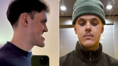 Man Bullied for Underbite Waits 6 Years for Surgery