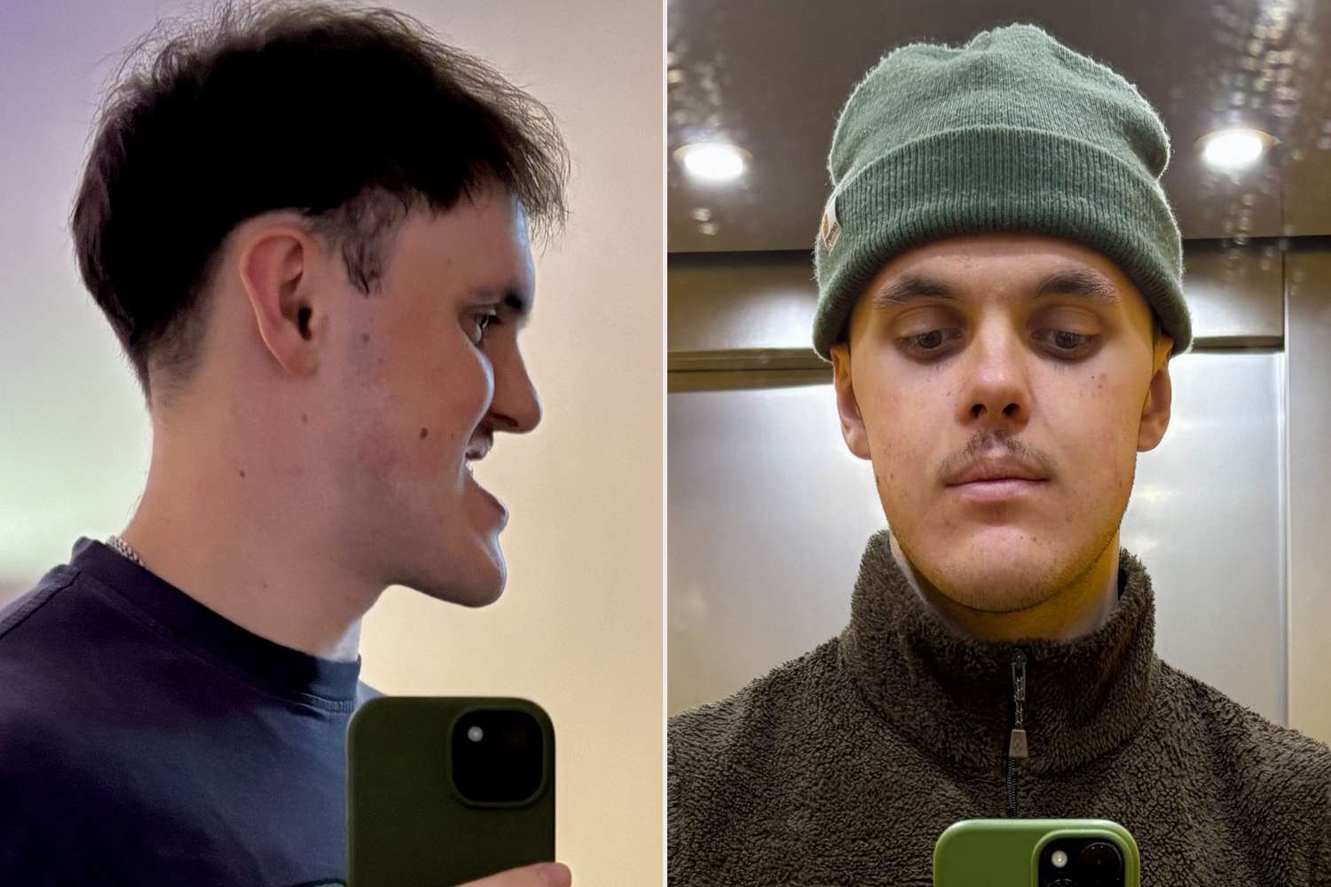 Man Bullied for Underbite Waits 6 Years for Surgery Man Bullied for Underbite Waits 6 Years for Surgery