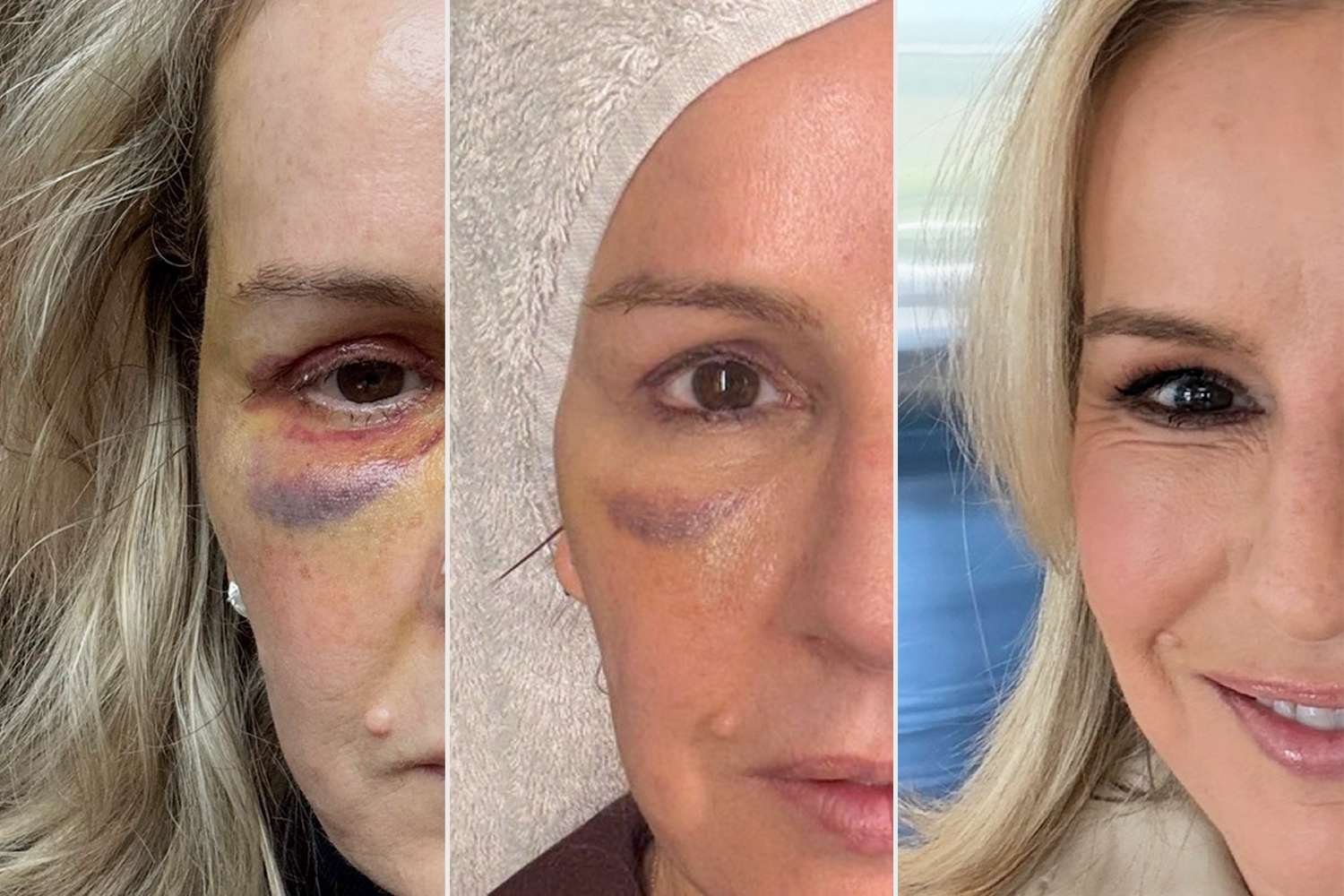 Doctor, 56, Gets Bleph amid Health Journey Before-and-After Photos (Exclusive)