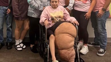 Florida Teen with Rare Condition Has 174-lb. Leg Amputated