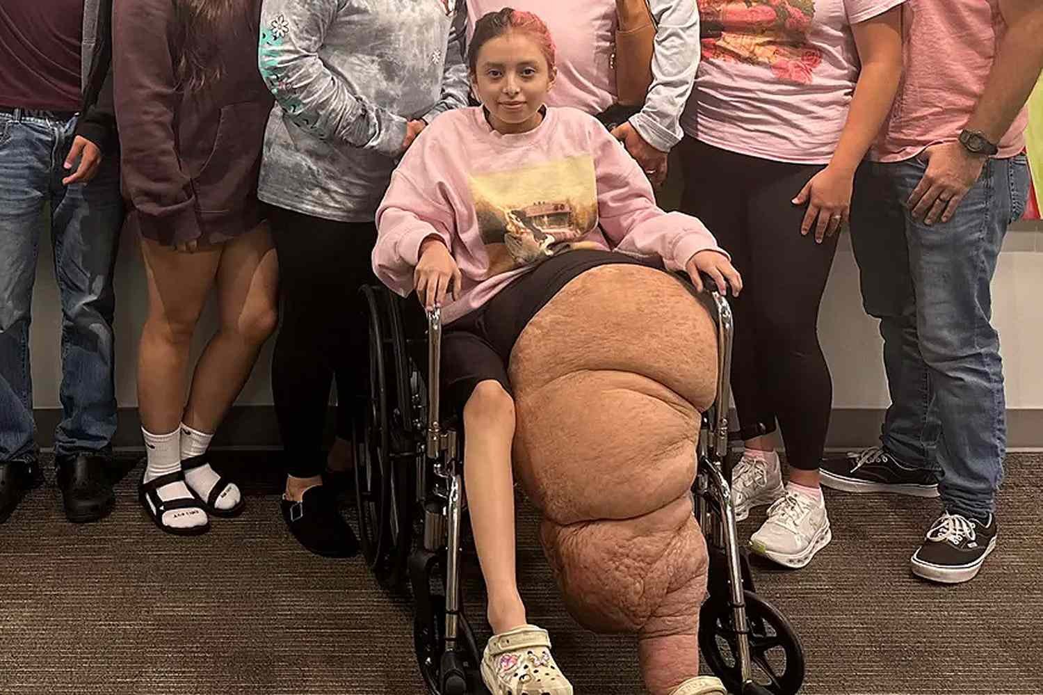 Florida Teen with Rare Condition Has 174-lb. Leg Amputated