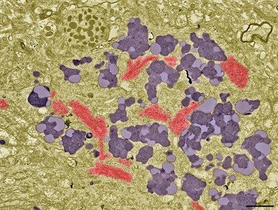 How common is Alzheimer’s? Blood-test study holds surprises How common is Alzheimer’s? Blood-test study holds surprises