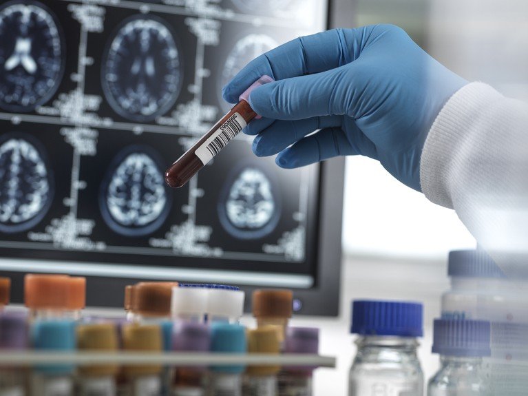 How common is Alzheimer’s? Blood-test study holds surprises How common is Alzheimer’s? Blood-test study holds surprises