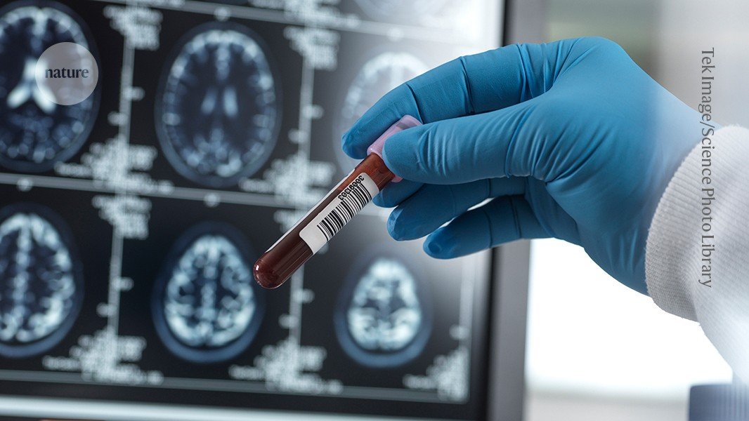 How common is Alzheimer’s? Blood-test study holds surprises How common is Alzheimer’s? Blood-test study holds surprises