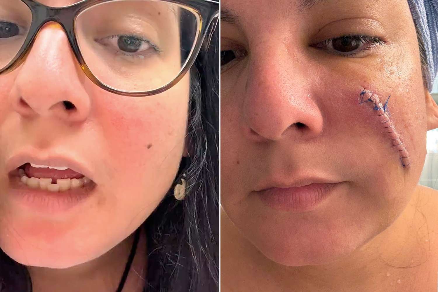 Woman Shocked After Taking Off Bandage from Skin Cancer Surgery (Exclusive) Woman Shocked After Taking Off Bandage from Skin Cancer Surgery (Exclusive)