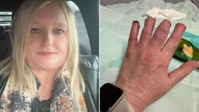 Woman Has Toes, Fingers Amputated After Kidney Stone Infection