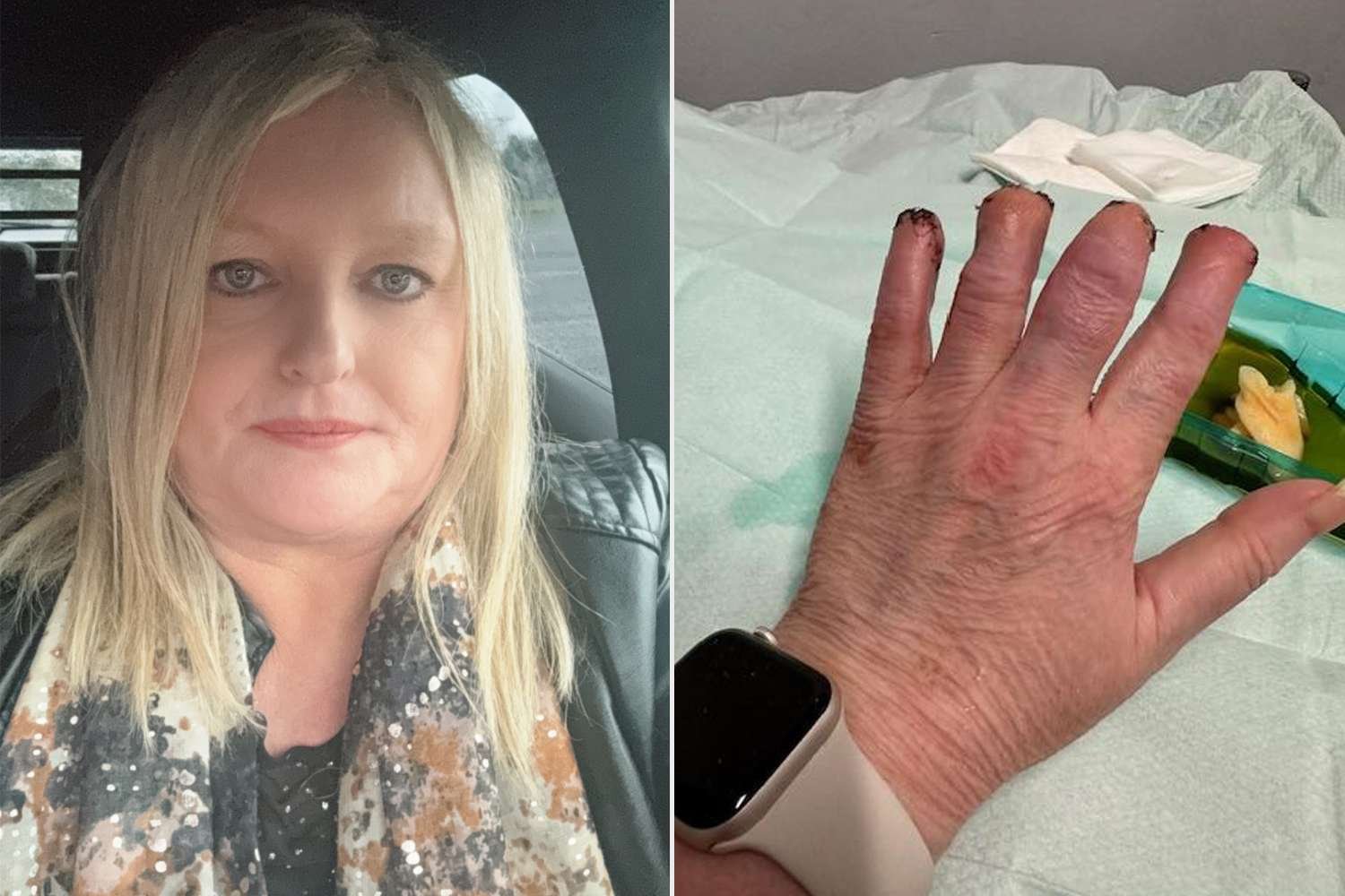 Woman Has Toes, Fingers Amputated After Kidney Stone Infection