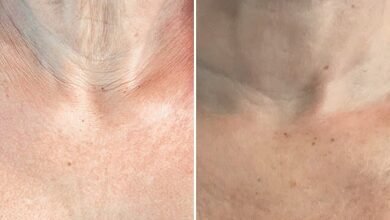 After losing 10kg on Ozempic I was left with saggy skin and thin hair Heres how I fixed them OLIVIA FALCON