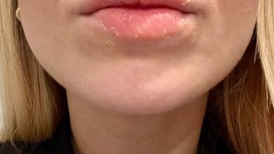 For decades Ive battled eczema on my face. I tried everything to fix it and nothing worked… until I hit on this simple formula. This is how its changed my life – and its surprisingly affordable